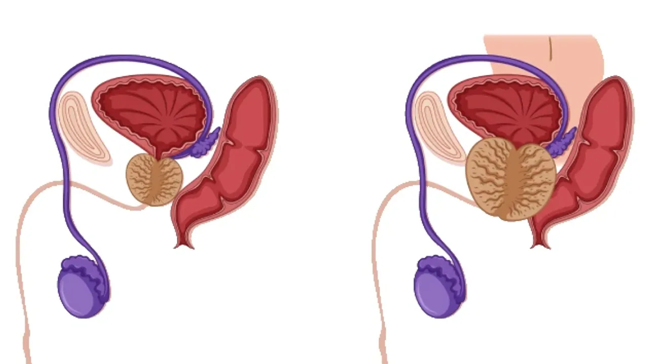 Prostat nedir? Prostat neden olur? Prostat belirtileri nelerdir?
