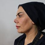 Kırılan burnunu düzeltmek isterken, hayatı kabusa döndü! Doktoruna dava açtı