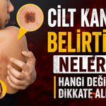 Cilt kanseri belirtileri nelerdir? Hangi değişimler dikkate alınmalı?