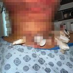 Gıdı estetiği sonrası faciayı yaşadı! Genç kadın boynundan nasıl acil solunum yolu açıldığını anlattı