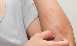 Alerji kaşıntısı nasıl olur? Belirtiler ve nedenleri