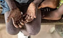 Afrika CDC, M çiçeği salgınını kıtada sağlık acil durumu ilan etti