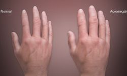 Akromegali hastalığı nedir?