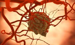Metastas nedir? Belirtileri, oluşum süreci ve tedavi yöntemleri neledir