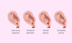 Plasenta Previa nedir?