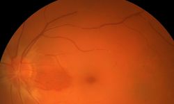 Prematüre Retinopatisi nedir? Genel bakış ve risk faktörleri
