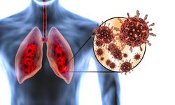 Akciğer enfeksiyonu nedir? belirtileri, nedenleri ve tedavi yöntemleri nelerdir?