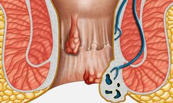 Hemoroid (basur) nedir, neden olur ve nasıl geçer?