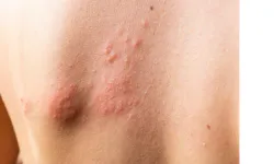 Histamin nedir, ne işe yarar? Histamin intoleransı belirtileri, nedenleri ve tedavi yöntemleri