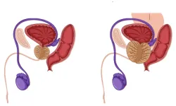 Prostat nedir? Prostat neden olur? Prostat belirtileri nelerdir?
