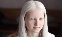 Albino hastalığı nedir, neden olur? Belirtileri ve tedavisi