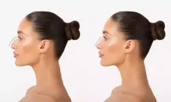 Almanya’dan emsal karar: Estetik ameliyatların “öncesi-sonrası” fotoğrafları yasaklandı