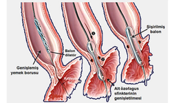 Dilatasyon nedir, ne anlama gelir, tıpta ne demek?