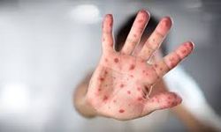 Zona hastalığı (Gece yanığı) nedir, kimlerde görülür? Zona hastalığı belirtileri, nedenleri ve tedavisi nelerdir?