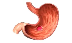 Midede inflamasyon nedir? Mide iltihabı neden olur?  Inflamasyon nasıl önlenir?