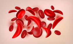 Orak hücre anemisi nedir? Orak hücre anemisi belirtileri nelerdir?