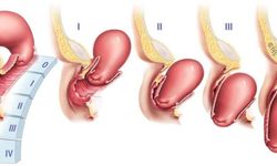 Rahim sarkması nedir? Rahim sarkması neden olur? Rahim sarkması belirtileri nelerdir?