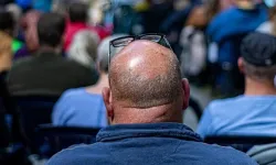 Saç dökülmesinde yeni umut: Tayvanlı bilim insanları 20 günde sonuç aldı