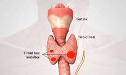 Tiroid nodülü nedir? Tiroid nodülü neden olur, belirtileri nelerdir?