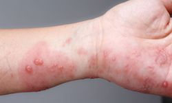 Uyuz belirtileri nelerdir? Geceleri kaşıntı neden olur, uyuz nasıl geçer, evde tedavi edilir mi?