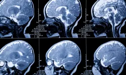 İngiltere’de yeni doğanlarda beyin hasarını tespit eden başlık geliştirildi