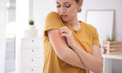 Kurdeşen (Ürtiker) nedir, neden olur ve nasıl geçer?