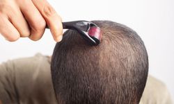 Dermaroller nedir? Dermaroller nasıl kullanılır? Dermaroller ne işe yarar?