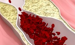 Embolizasyon nedir? Embolizasyon tedavisi nasıl yapılır?