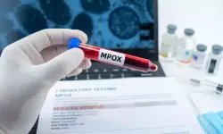 Maymun çiçeği alarmı! Yeni varyant tespit edildi