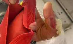 Sıcak su torbası faciası! Genç kızın vücudunun yüzde 25'i yandı