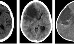 Hipodens lezyon nedir? Hipodens lezyon belirtileri nelerdir?