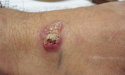 Hipoekoik lezyon nedir, hangi durumlarda görülür?