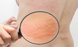 Histamin intoleransı nedir, belirtileri nelerdir? Hangi testlerle anlaşılır?