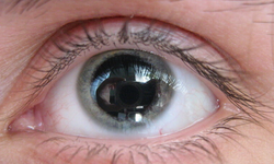 Midriyasiz nedir, zararları nelerdir? Ciddi bir hastalık mı?