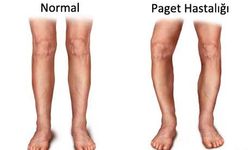 Paget hastalığı nedir? Paget hastalığı kimlerde görülür?