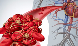 Pyelonefrit nedir, neden olur, nasıl tedavi edilir?