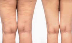 Selülitten kurtulmak mümkün mü?