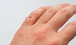 Siğil nasıl geçer? En etkili yöntemler, tedavi seçenekleri ve uzman ipuçları