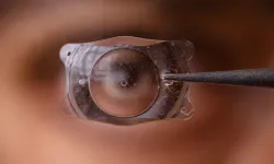 Smile lazer nedir, nasıl uygulanır?