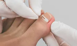 Tırnak mantarının belirtileri, erken teşhis hayat kurtarır