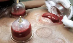 Hacamat nasıl yapılır? Hacamat kimlere yapılır, kimlere önerilmez?