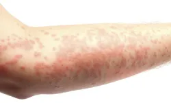 Histamin intoleransı nedir, belirtileri nelerdir ve hangi gıdalardan uzak durulmalıdır?