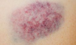 Morluklar nasıl geçer, ne kadar sürer?