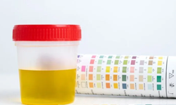 Spesifik gravite nedir, sonuç aralığı ne olmalı, idrar tahlilinde ne anlama gelir?