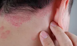 Temre nedir, neden olur ve nasıl geçer? Temre belirtileri ve tedavi yöntemleri nelerdir?