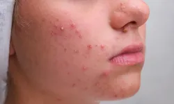 Ergenlik bitti, sivilceler bitmedi! Doç. Dr. Zeynep Altan Ferhatoğlu’ndan yetişkin aknesi uyarısı