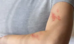 Suçiçeği geçirenler dikkat: Zona virüsü yeniden aktifleşebilir!