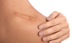Keloid neden oluşur? Nasıl geçer?
