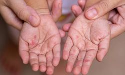 İngiltere'de kızamık alarmı: 2 çocuk hayatını kaybetti
