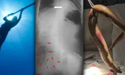 Balık avına çıkan yaşlı adamın içine yılan balığı girdi: Tıp dünyası şokta!